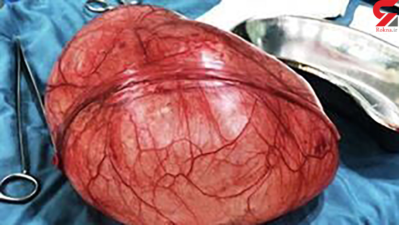 راز برآمدگی 30 سانتی زن 63 ساله در بیمارستان دهدشت فاش شد راز برآمدگی 30 سانتی زن 63 ساله در بیمارستان دهدشت فاش شد