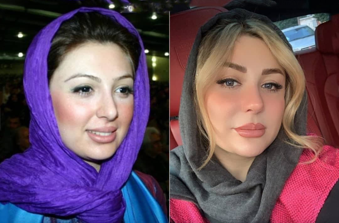 عکس دیده نشده نیوشا ضیغمی قبل از عمل زیبایی
