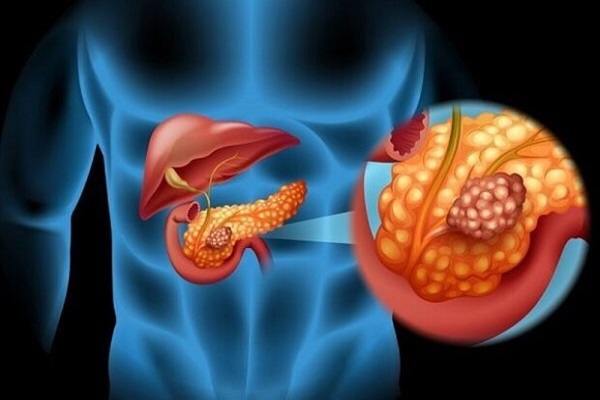 راه های پیشگیری از سرطان + شایع ترین سرطان ها در ایران