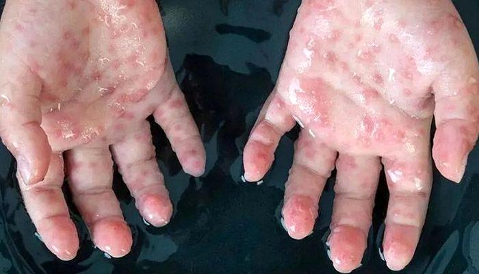 هشدار «مینو محرز» درباره بیماری آبله میمونی هشدار «مینو محرز» درباره بیماری آبله میمونی