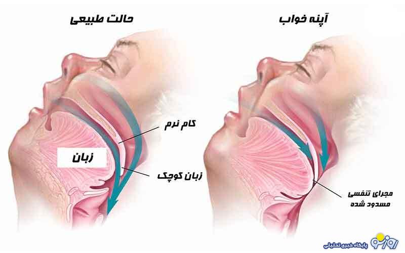 آپنه خواب چیست؟
