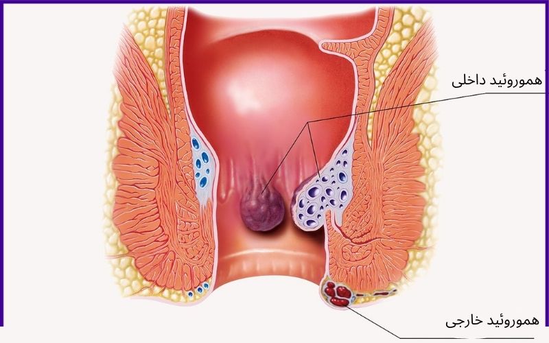بواسیر چیست و چه علائمی دارد؟ علت بیماری هموروئید را بشناسید! بواسیر چیست و چه علائمی دارد؟ علت بیماری هموروئید را بشناسید!